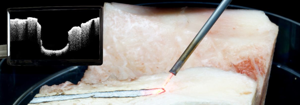 Research on how to make high-precision bone removal without endangering deeper tissue layers