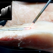 Research on how to make high-precision bone removal without endangering deeper tissue layers